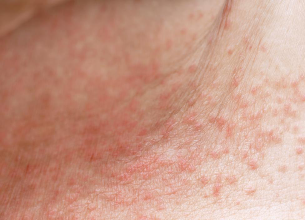 Bilde av varmeutslett