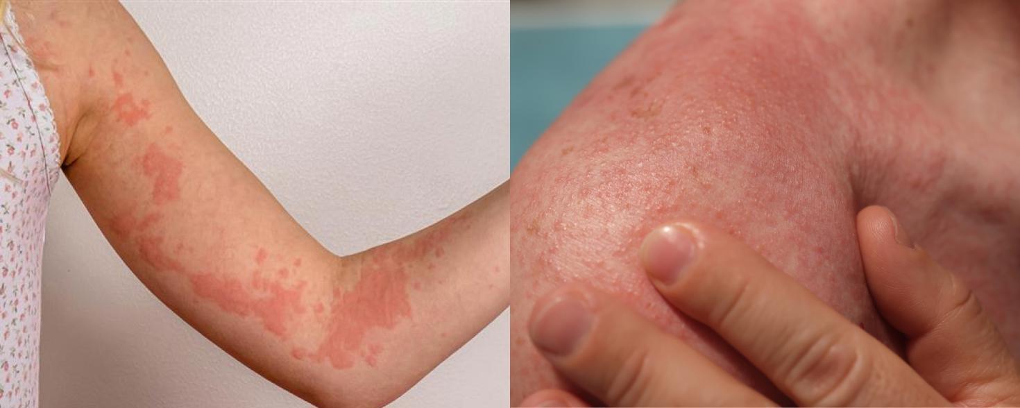 Bilde av elveblest på arm og varmeutslett på skulder