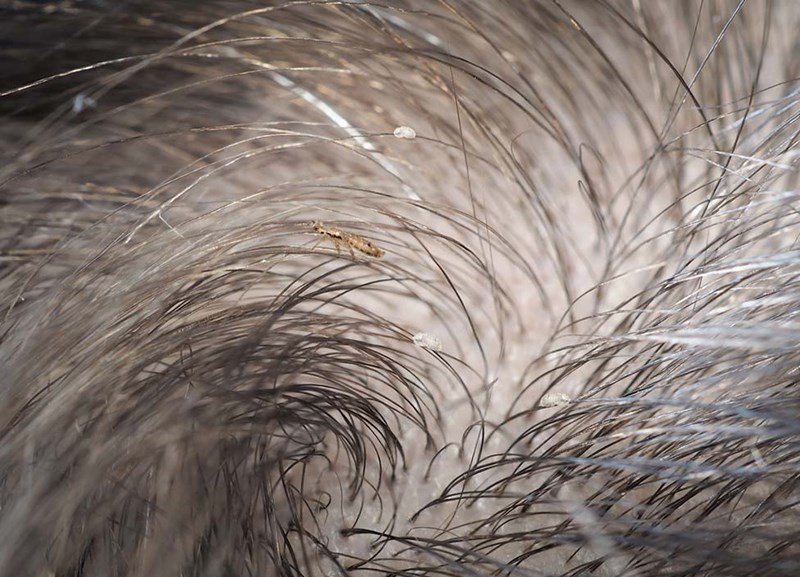 Nærbilde av hodelus og egg fra lus lagt i håret