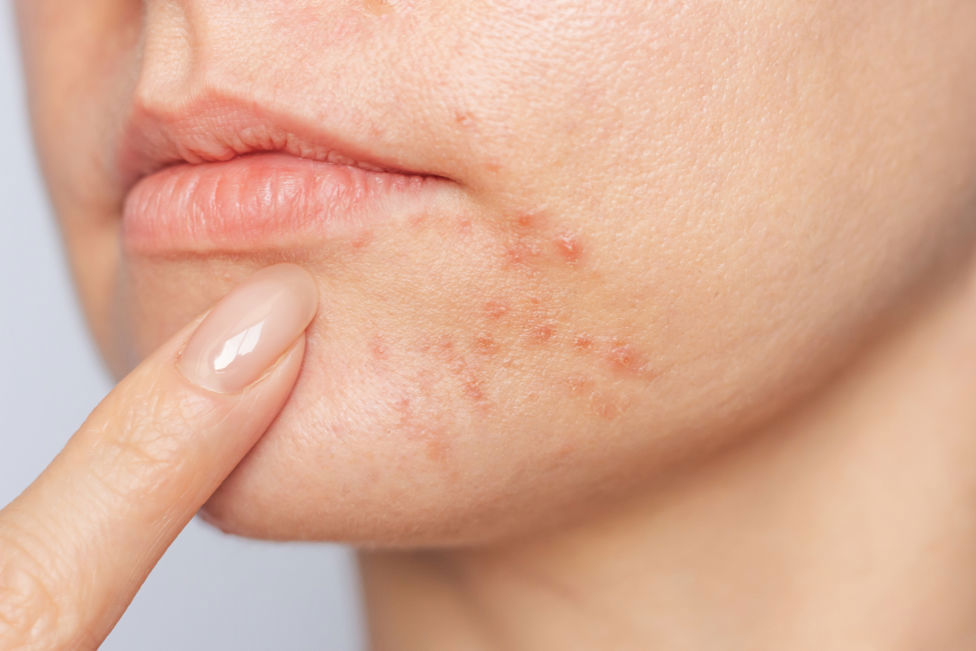 Kvinne med perioral dermatitt rundt munnen