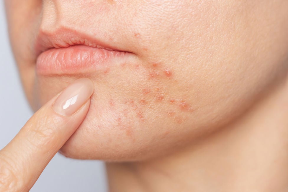 Kvinne med perioral dermatitt rundt munnen
