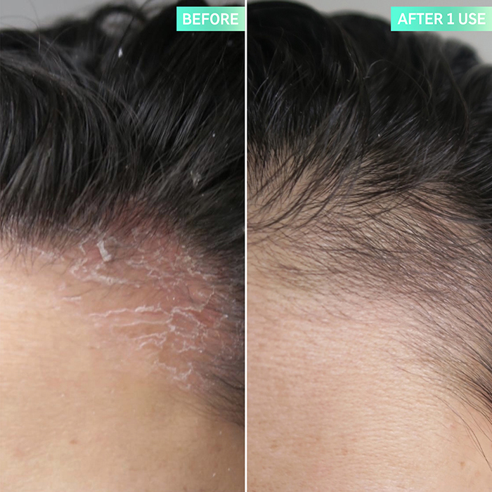 The Inkey List Salicylic Acid Exfoliating Scalp Treatment, 150 ml